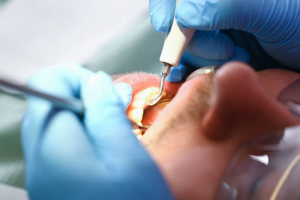 Best Emergency Wisdom Teeth Removal in Fairlea, WV